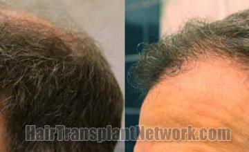 Before and after hair replacement - Left view