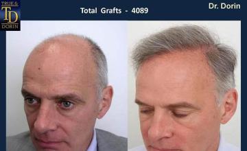 Left view - Before and after hair transplant results