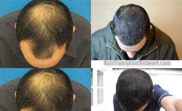 Hair restoration surgery before and after photos