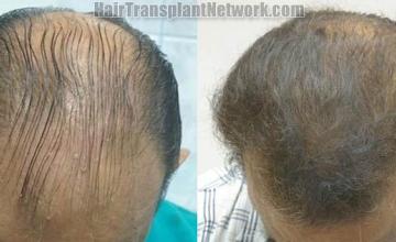 Before and after hair transplantation images