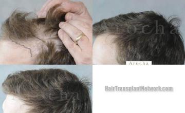 Hair restoration procedure before and after results