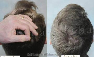 Hair transplantation surgery before and after photos