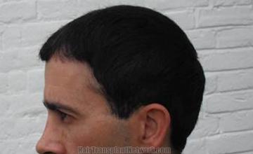 Hair transplantation surgery before and after pictures