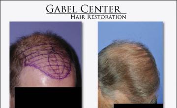 Before and after hair transplant procedure images