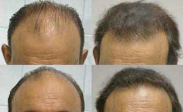 Front view - Before and after hair transplantation