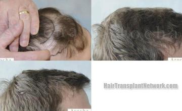 Before and after hair transplantation result photographs