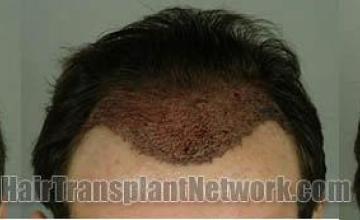 Hair restoration surgical result pictures