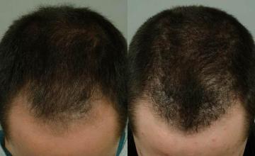 Top view before and after hair transplant procedure 