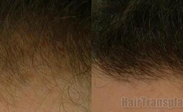 Close ups of hairlines before and after hair transplant