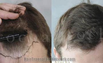 Before and after hair transplant procedure images