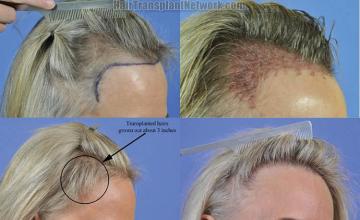 Right view before and after hair transplant procedure