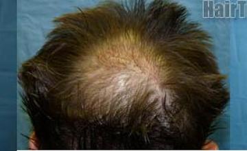 View of patient's crown before and after hair restoration