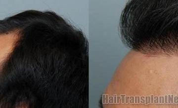 Hair transplantation surgery before and after photos