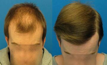 Hair restoration surgery before and after photos