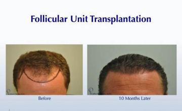 Hair restoration procedure before and after pictures