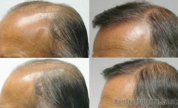 Left view before and after hair restoration images