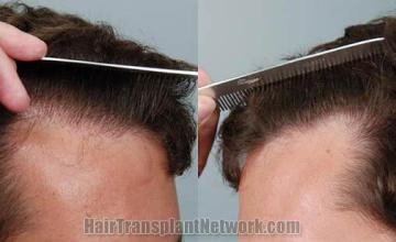 Surgical hair transplantation result photographs