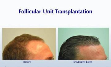 Hair transplantation surgery before and after images