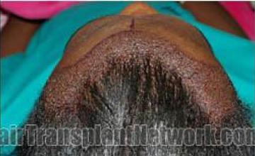 Immediate postoperative hair transplant images