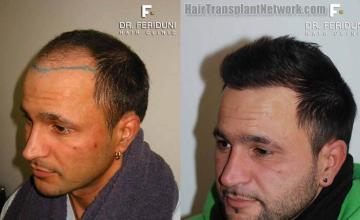 Left view before and after hair transplant procedure