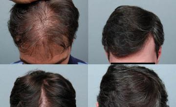 Top view - Before and after hair transplant repair