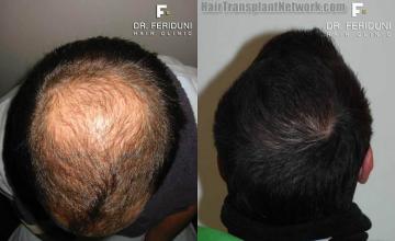 Views of the crown before and after hair transplant