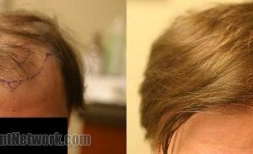 Hair restoration procedure before and after results