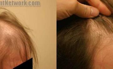 Hair transplantation surgery before and after pictures