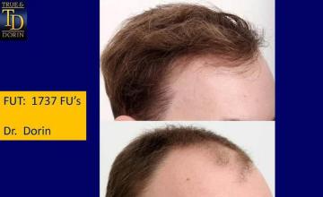 Hair restoration procedure before and after results