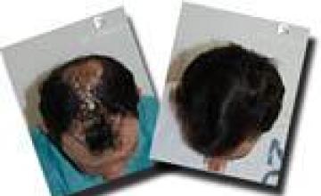 Hair restoration procedure before and after results