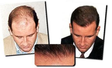 Hair restoration procedure results