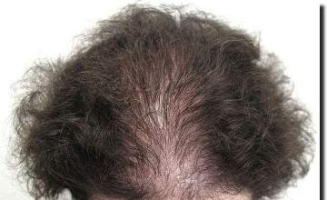 Hair restoration procedure results