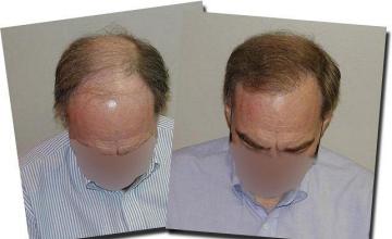 Hair restoration procedure results