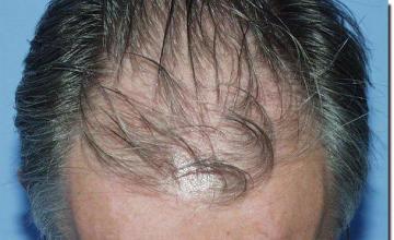 Hair restoration procedure results