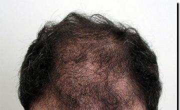 Hair restoration procedure results