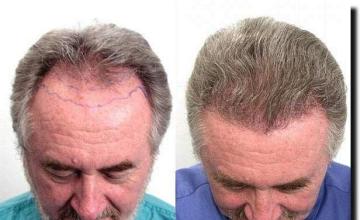 Hair restoration procedure results