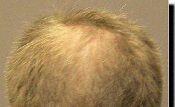 Hair restoration procedure results