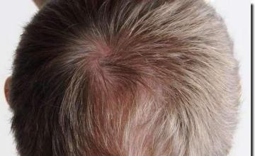 Hair restoration procedure results