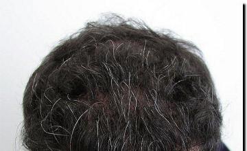 Hair restoration procedure results