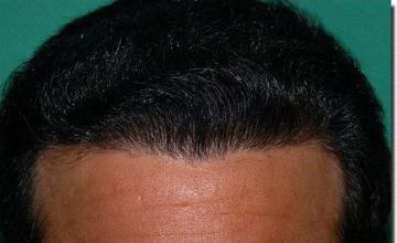 Hair restoration procedure results