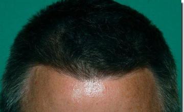 Hair restoration procedure results