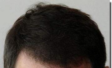 Hair restoration procedure results