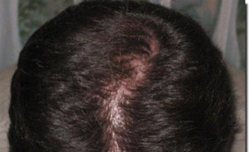 Hair restoration procedure results