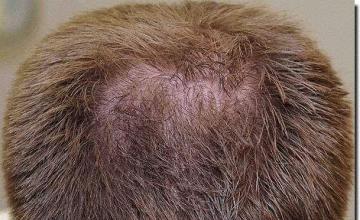 Hair restoration procedure results