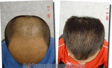 Hair restoration procedure results