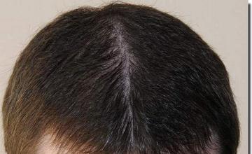 Hair restoration procedure results