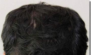 Hair restoration procedure results