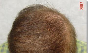 Hair restoration procedure results