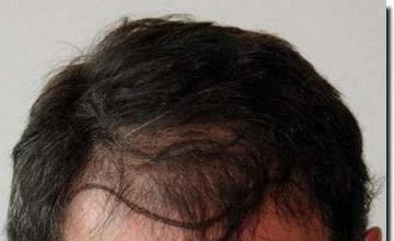 Hair restoration procedure results