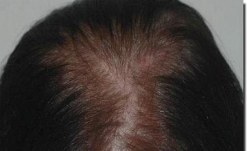 Hair restoration procedure results